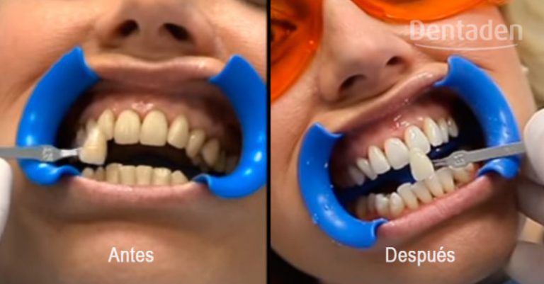 blanqueamiento dental clinica