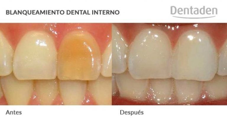 blanqueamiento dental interno