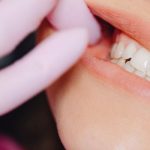 bolsas periodontales