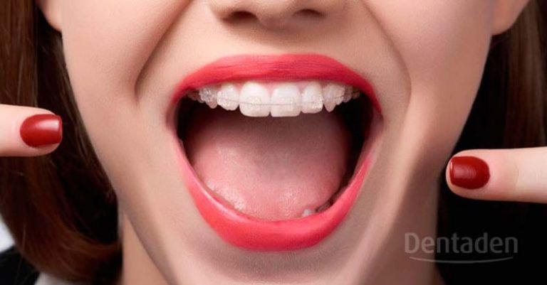 brackets estetico