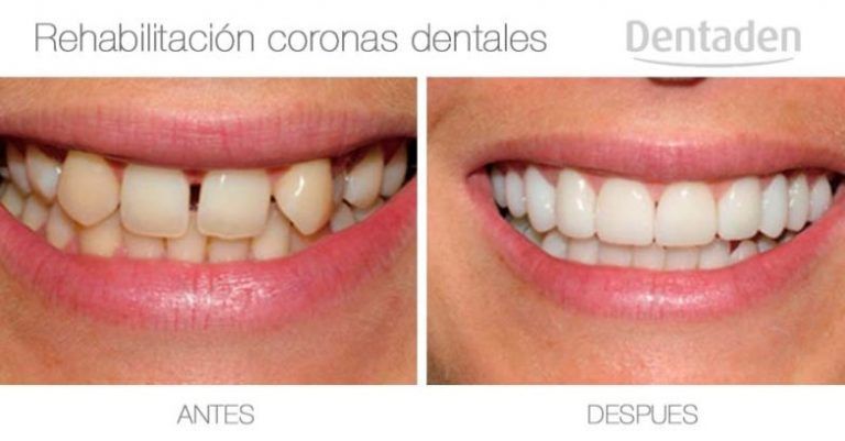 coronas dentales
