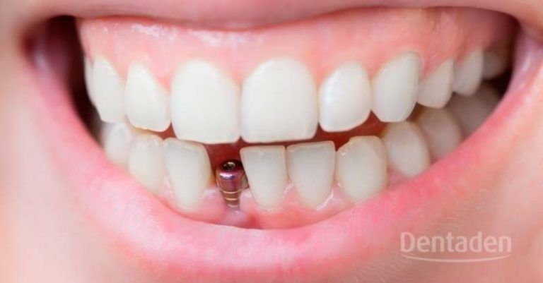 dudas implantes dentales