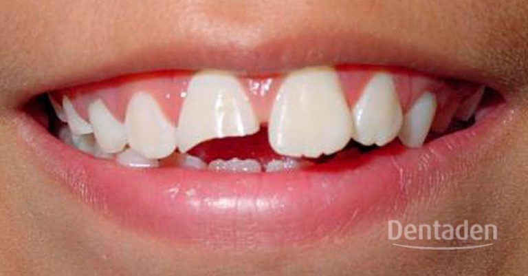 fractura dental