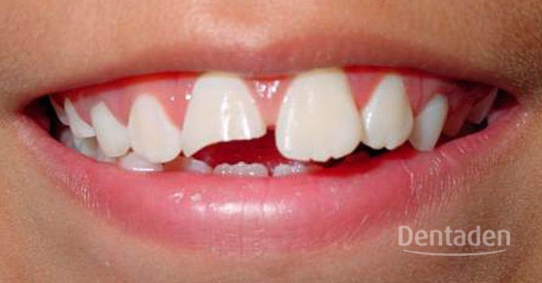 fractura dental