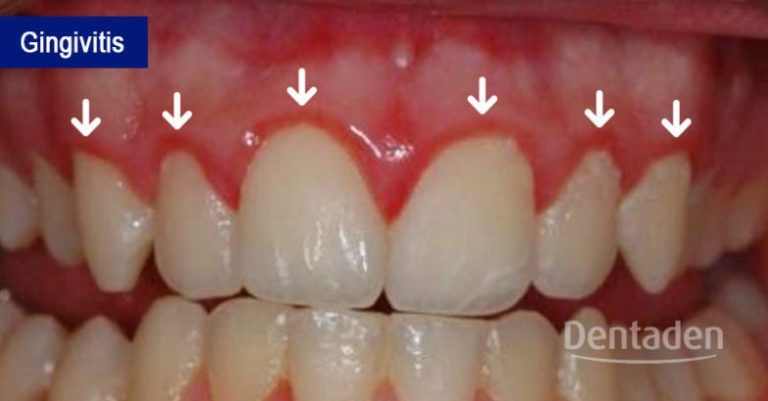 gingivitis