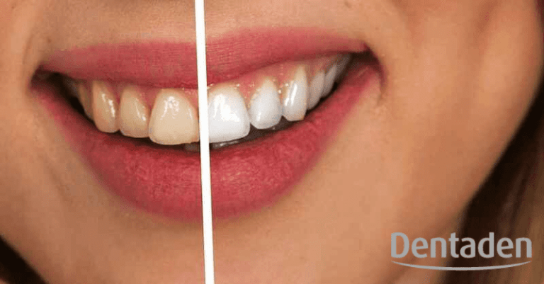 Cómo blanquear los dientes