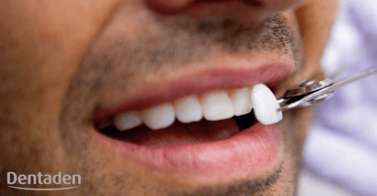 carillas de porcelana