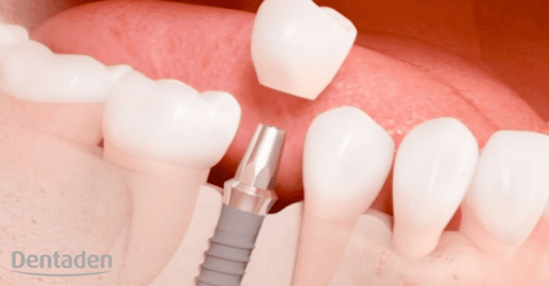 implante dental