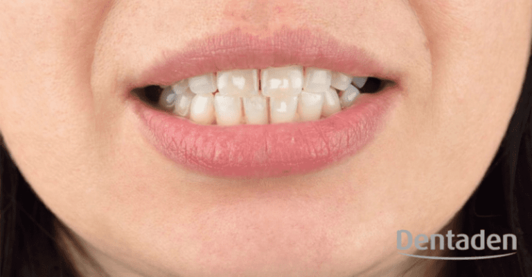 hipoplasia dental