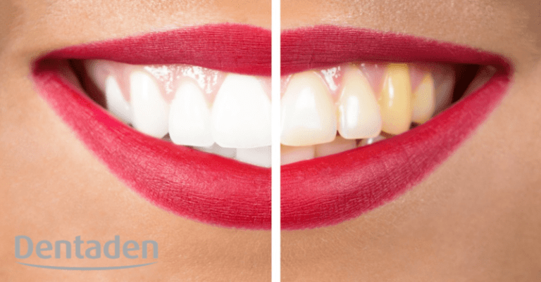 trucos para blanquear los dientes