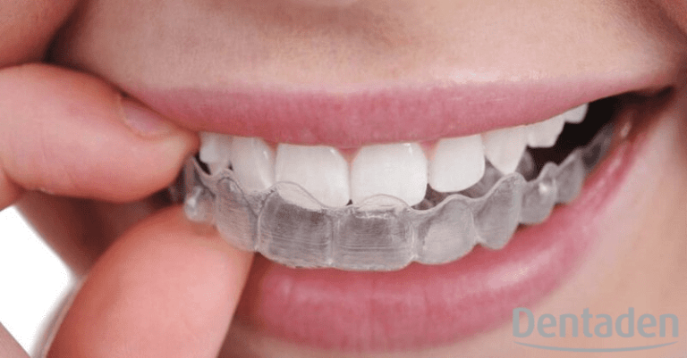 férula dental