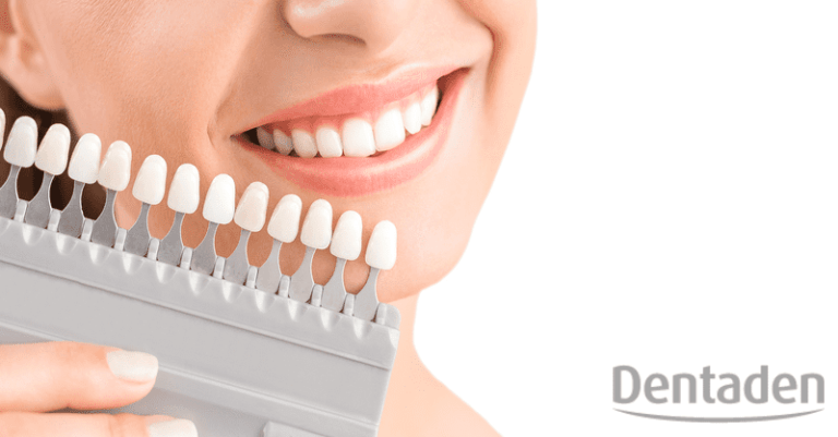 tipos de carillas dentales