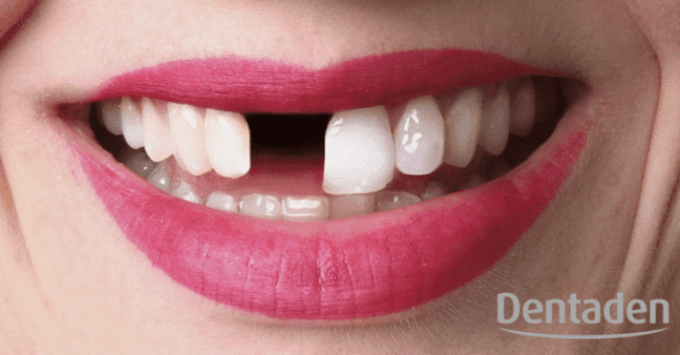 Pérdida de un implante dental