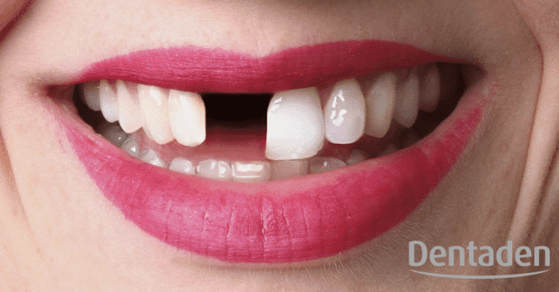 Pérdida de un implante dental