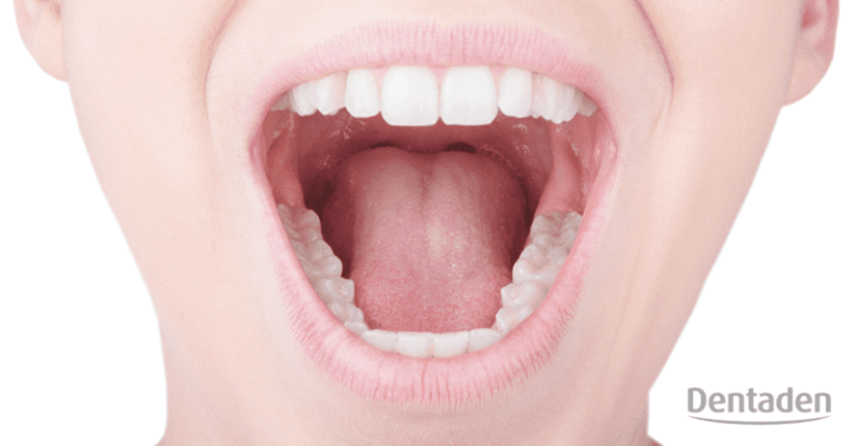 leucoplasia oral