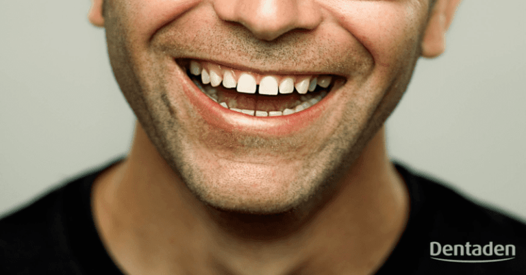 diastema