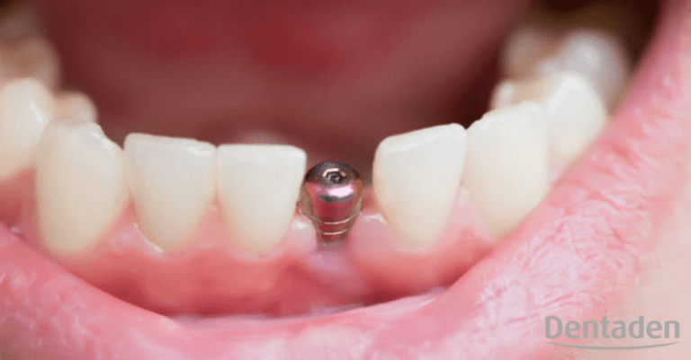 riesgo de los implantes dentales
