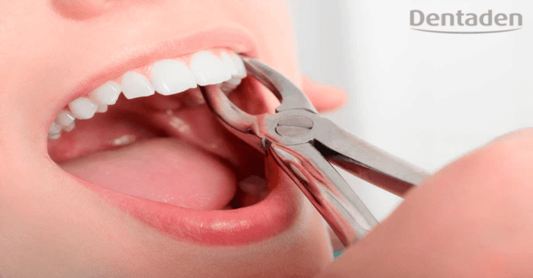 extracción dental