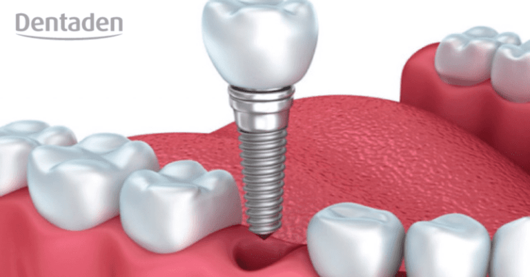 osteointegracion