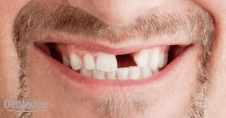 evitar perder los dientes