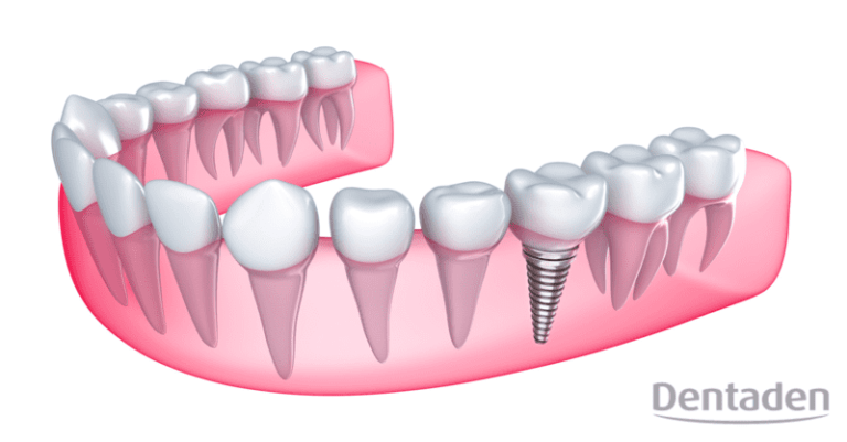 implantes dentales