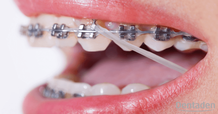 apiñamiento dental