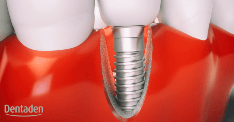 periimplantitis