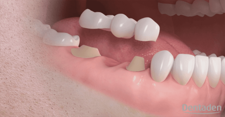 durabilidad de un implante dental