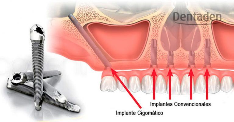 implantes cigomaticos