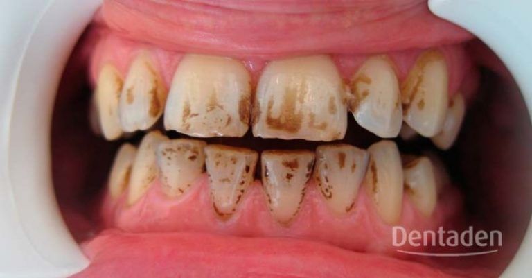 manchas dientes