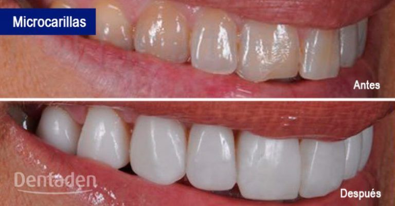 microcarillas dentales
