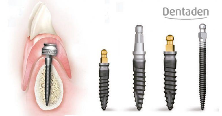 microimplantes
