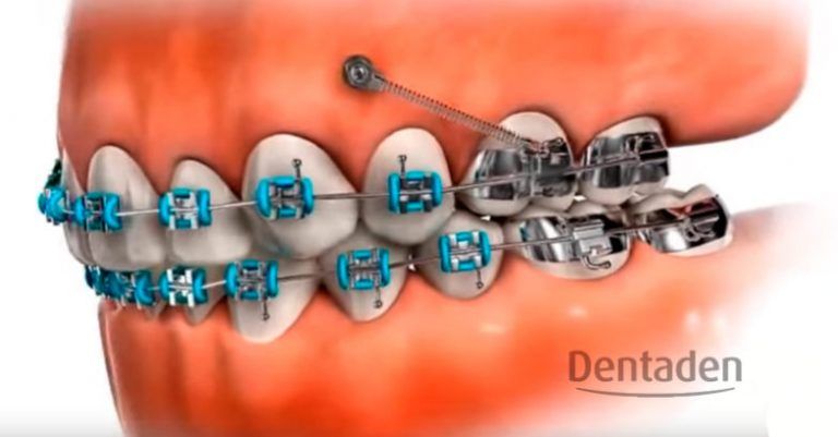 microimplantes de ortodoncia