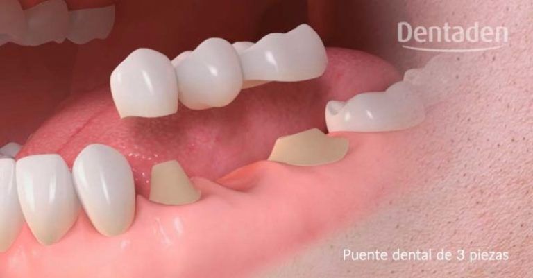 puente dental