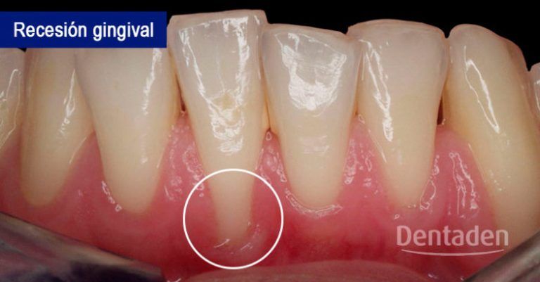 recesion gingival